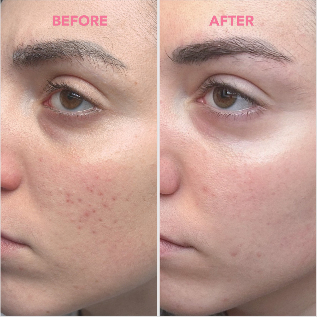 Tea glow blemish cream con infuso di tè verde e niacinamide - prima del suo utilizo e dopo 4 settimane effetti