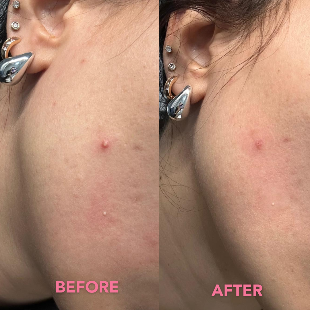 Tea Glow patch idrocolloidali anti-imperfezioni, anti-brufoli con tè verde, acido salicilico, niacinamide - before and after a night of use