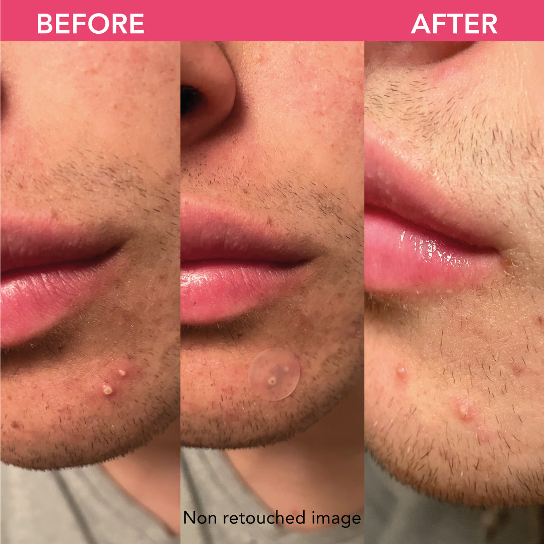 Tea Glow patch idrocolloidali anti-imperfezioni, anti-brufoli con tè verde, acido salicilico, niacinamide